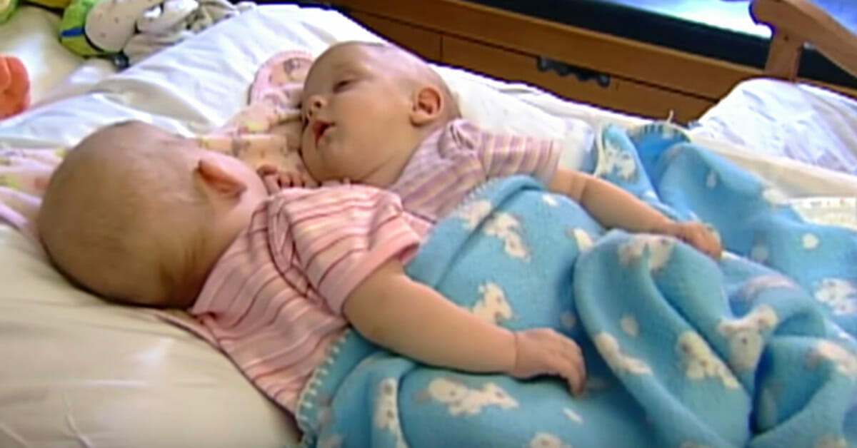 10 Years Ago These Conjoined Twins Were Separated Through Advanced Surgery Now They Are All 2685